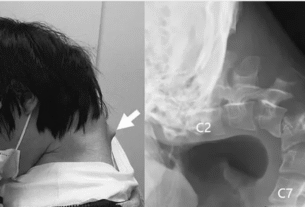 droping head syndrome