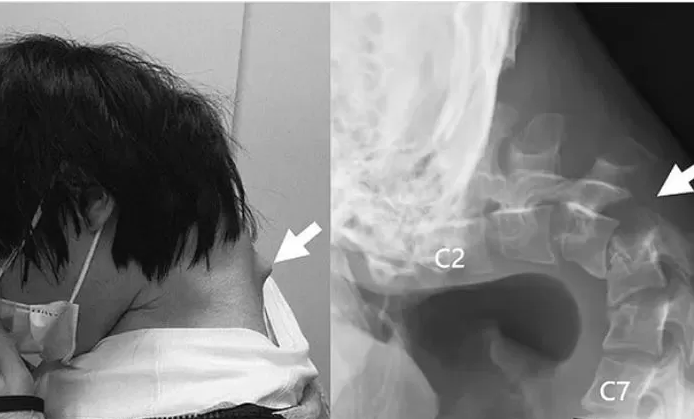 droping head syndrome